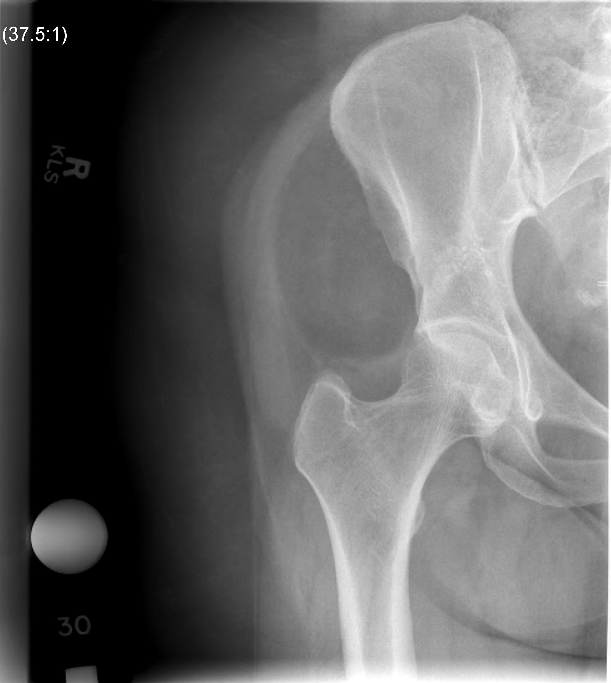 Liposarcoma Xray